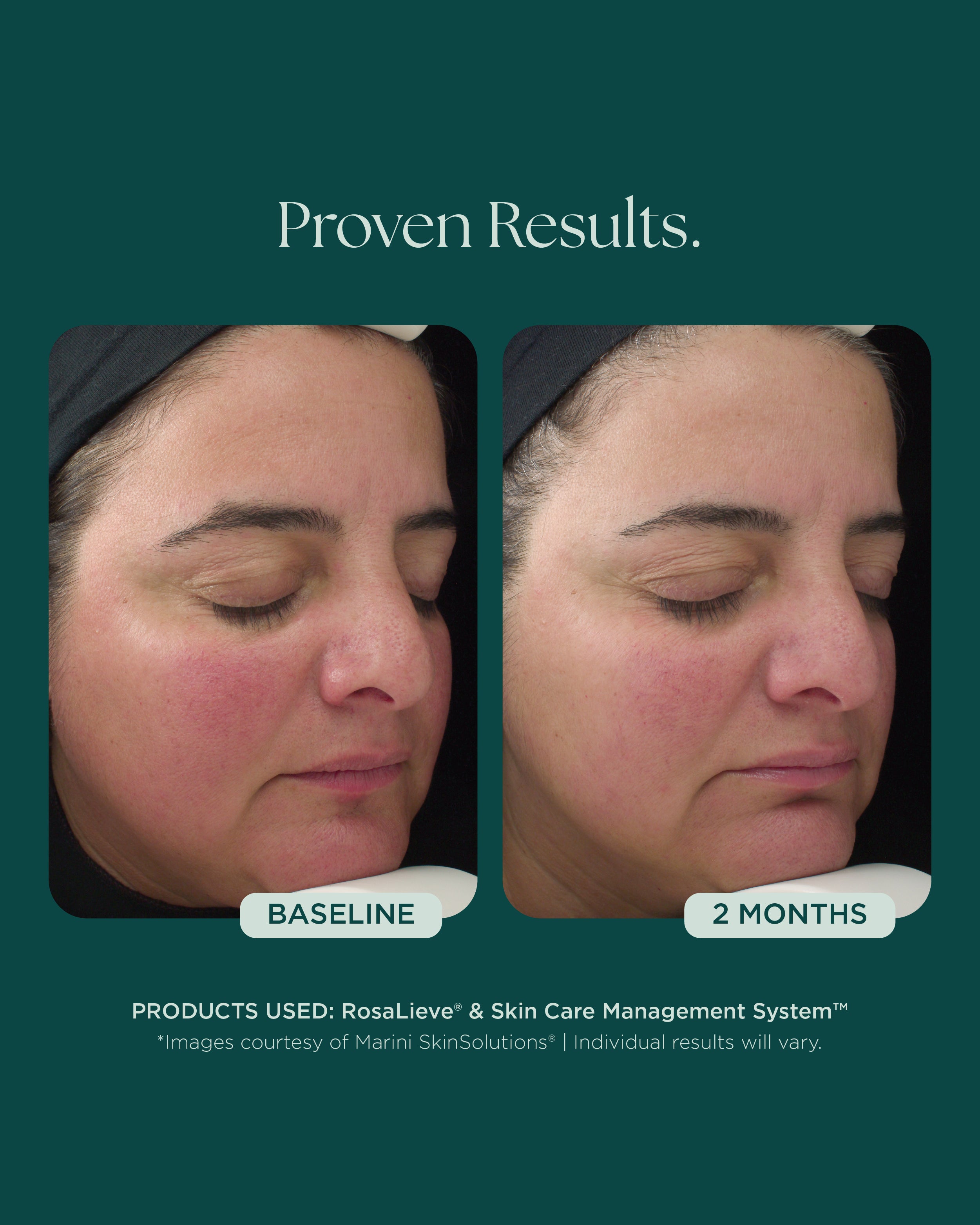 RosaLieve® Redness Reducing Complex