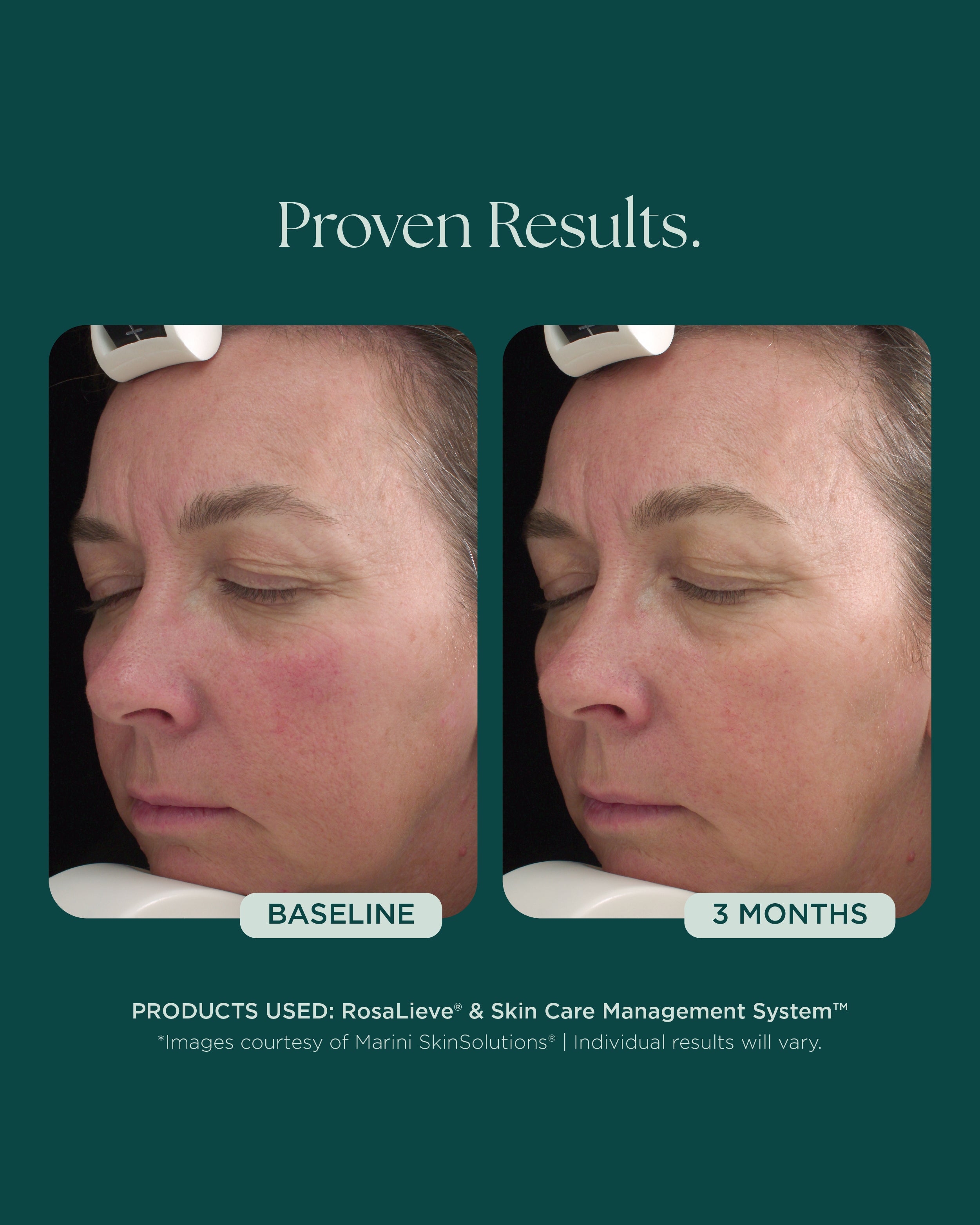 RosaLieve® Redness Reducing Complex